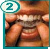 Applying Teeth Whitener Mouthpiece